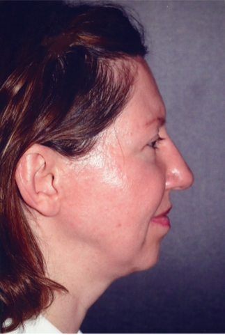 Neck Liposuction, Platysmaplasty, Chin Implant Before