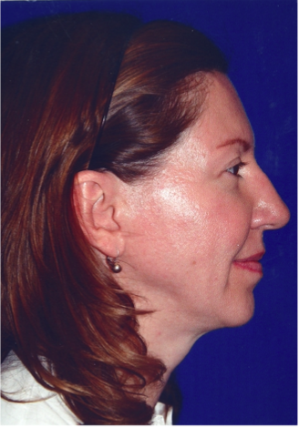 Neck Liposuction, Platysmaplasty, Chin Implant After