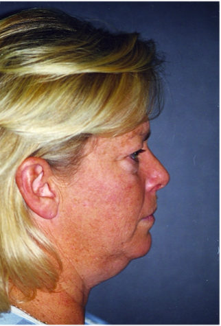 Neck Liposuction, Platysmaplasty, Chin Implant Before