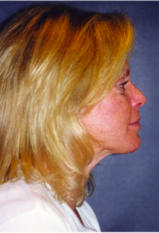 Neck Liposuction, Platysmaplasty, Chin Implant After