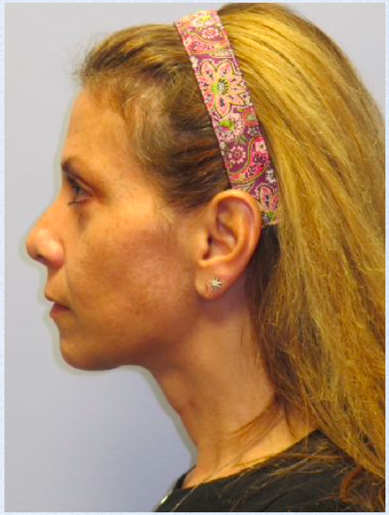 Neck Liposuction, Platysmaplasty, Chin Implant After