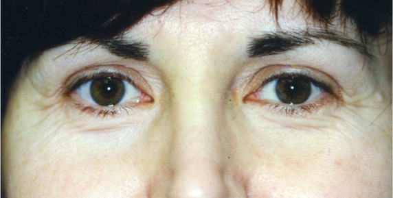 Eyelid Surgery Before