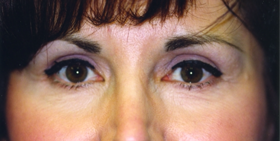 Eyelid Surgery After