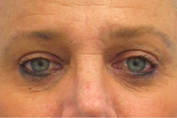 Eyelid Surgery After