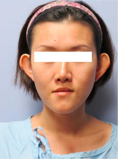 Otoplasty Before