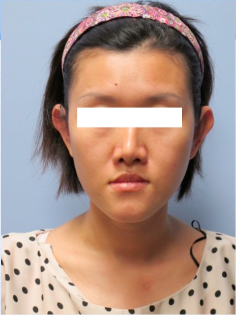 Otoplasty After