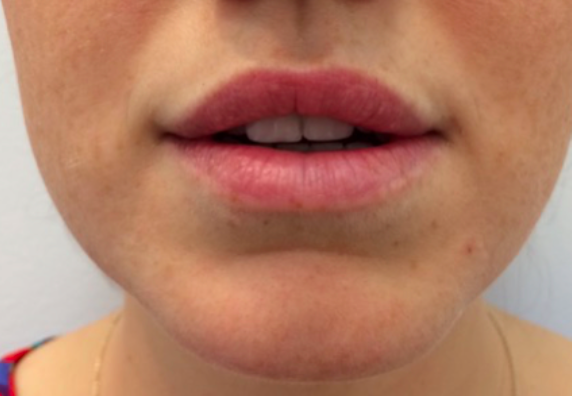 Lip Enhancement Before