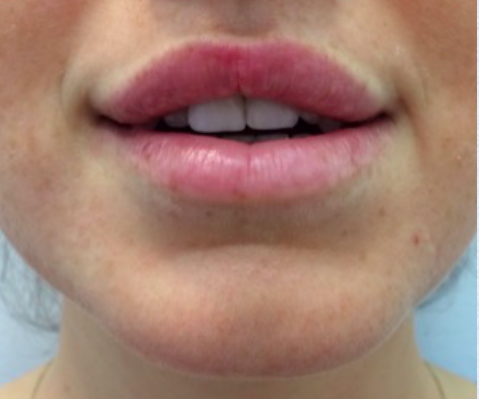 Lip Enhancement After