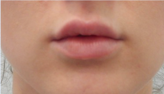 Lip Enhancement Before