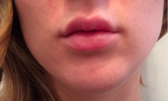 Lip Enhancement After