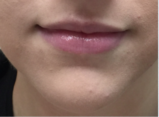 Lip Enhancement Before