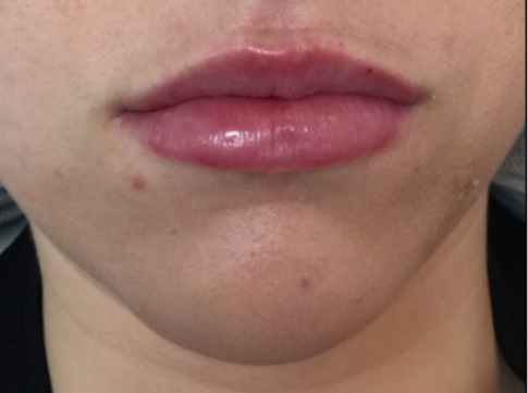 Lip Enhancement After