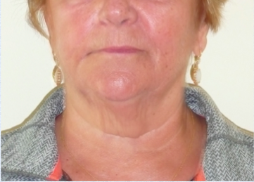 Microneedling with PRP After