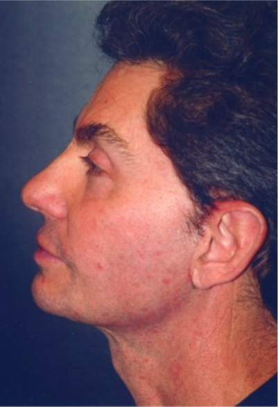 Male Facial Procedures After