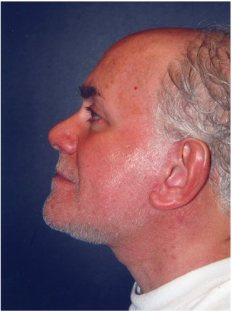 Male Facial Procedures After