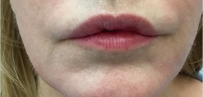 Lip Reduction Before