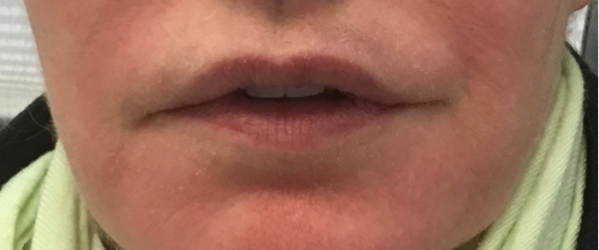 Lip Reduction After