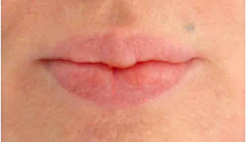 Lip Reduction Before