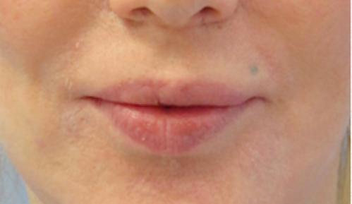 Lip Reduction After