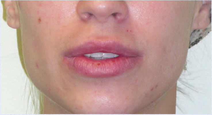 Lip Reduction Before