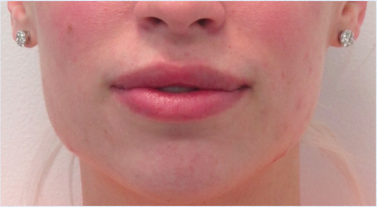 Lip Reduction After