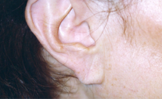 Earlobe Repair After