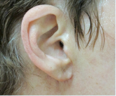 Earlobe Repair After