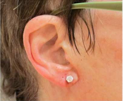 Earlobe Repair After