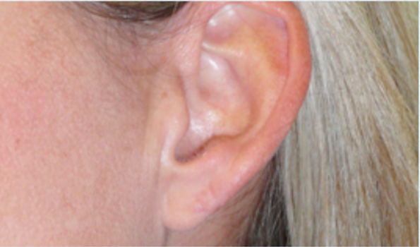 Earlobe Repair After