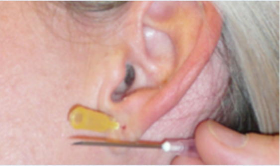 Earlobe Repair After