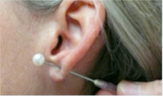 Earlobe Repair Before