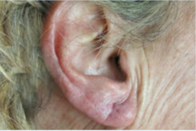 Earlobe Repair After