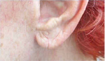 Earlobe Repair After