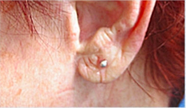 Earlobe Repair After