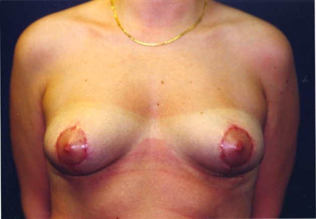 Breast Lift After