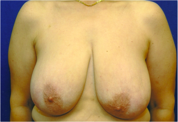 Breast Lift Before