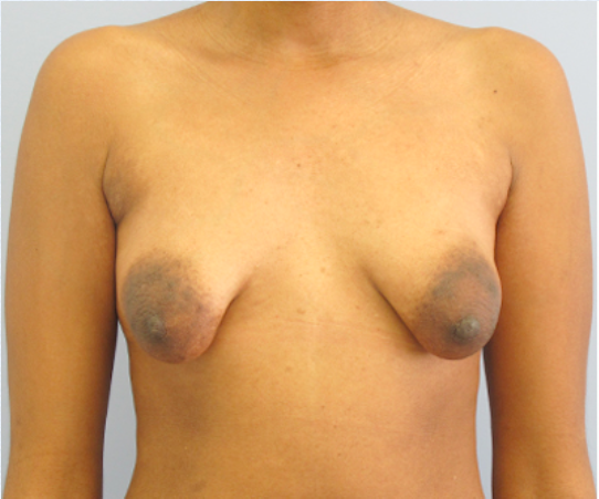 Tubular Breast Syndrome Before