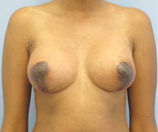 Tubular Breast Syndrome After