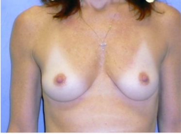 Breast Implants Before