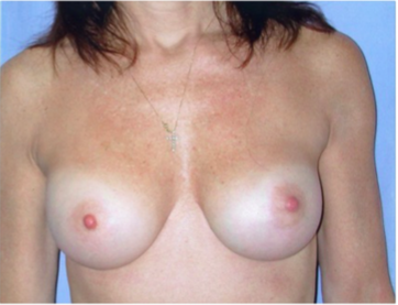 Breast Implants After