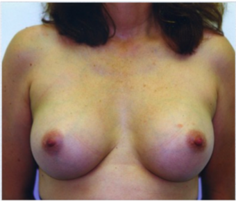 Breast Implants After