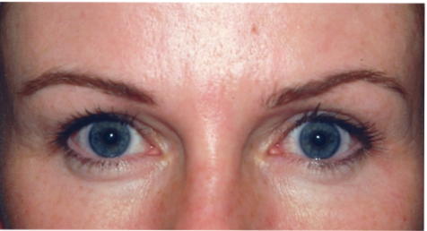 Eyelid Surgery After