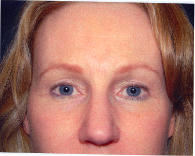 Eyelid Surgery After