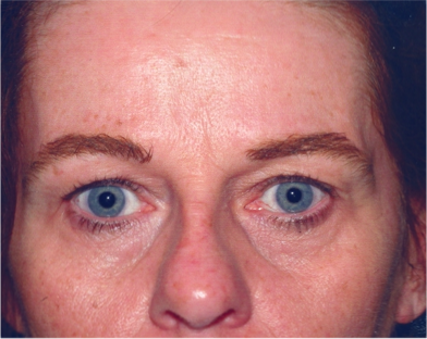 Eyelid Surgery Before