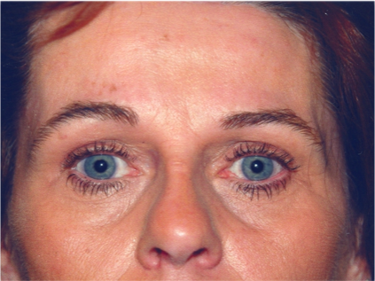 Eyelid Surgery After