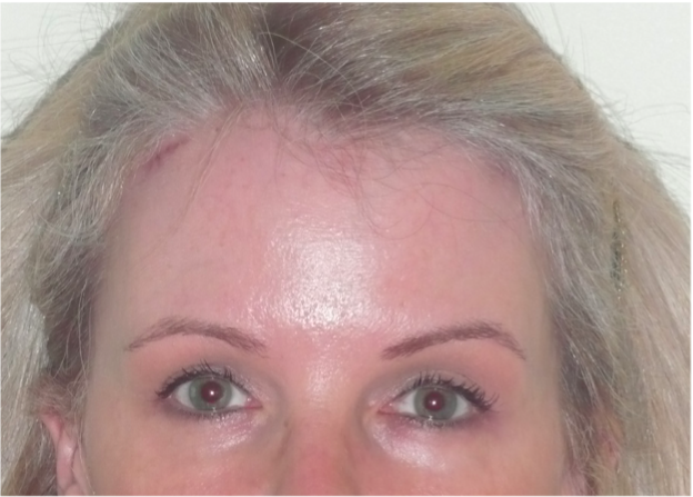 Eyelid Surgery After