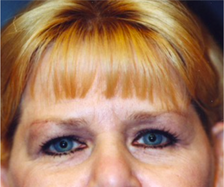 Brow Lift Before