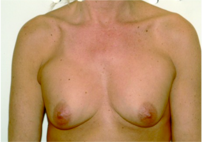 Breast Implant Correction Before