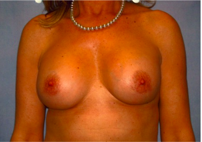 Breast Implant Correction After