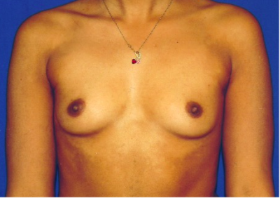 Breast Implant Correction Before